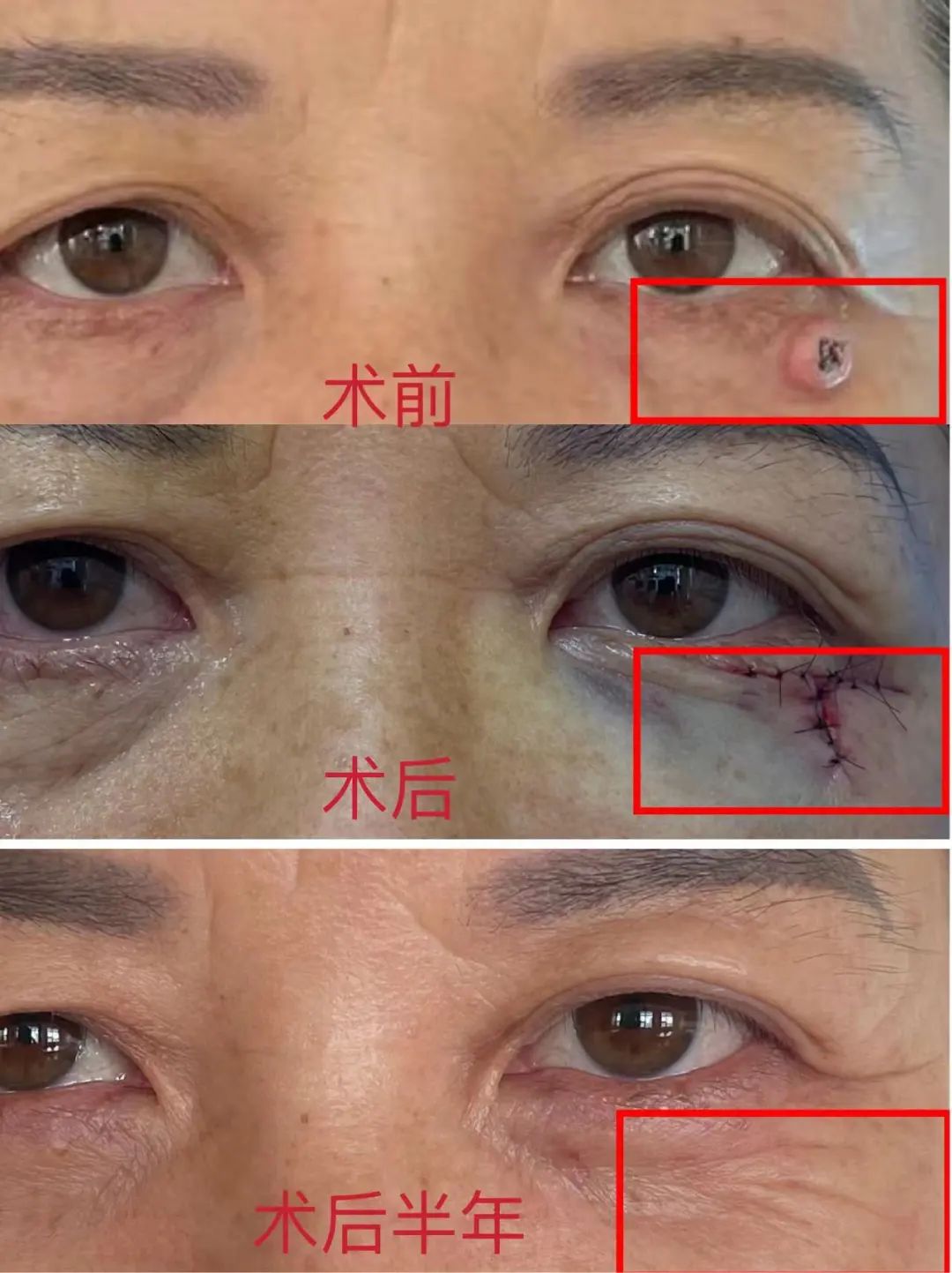 人各有“痣”，长在这些部位的痣易癌变！ABCDE法自测危险程度