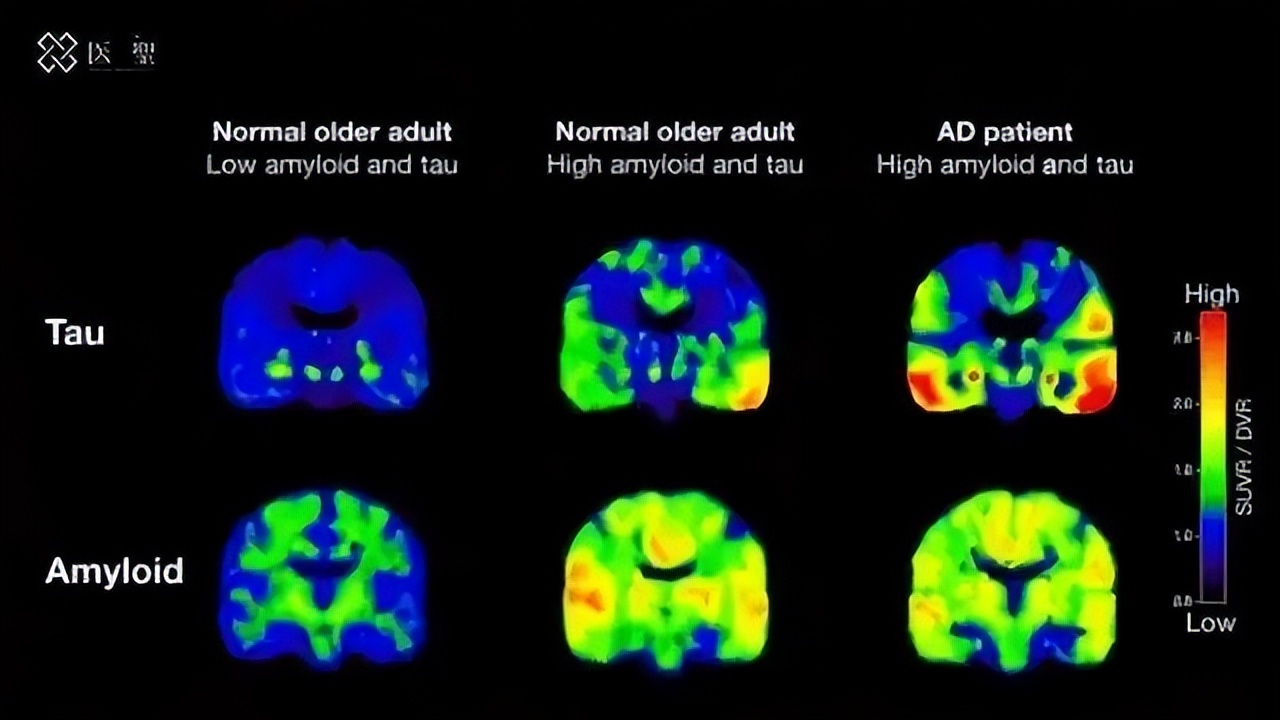干细胞治疗阿尔茨海默病,日本干细胞疗法治疗脑血管病