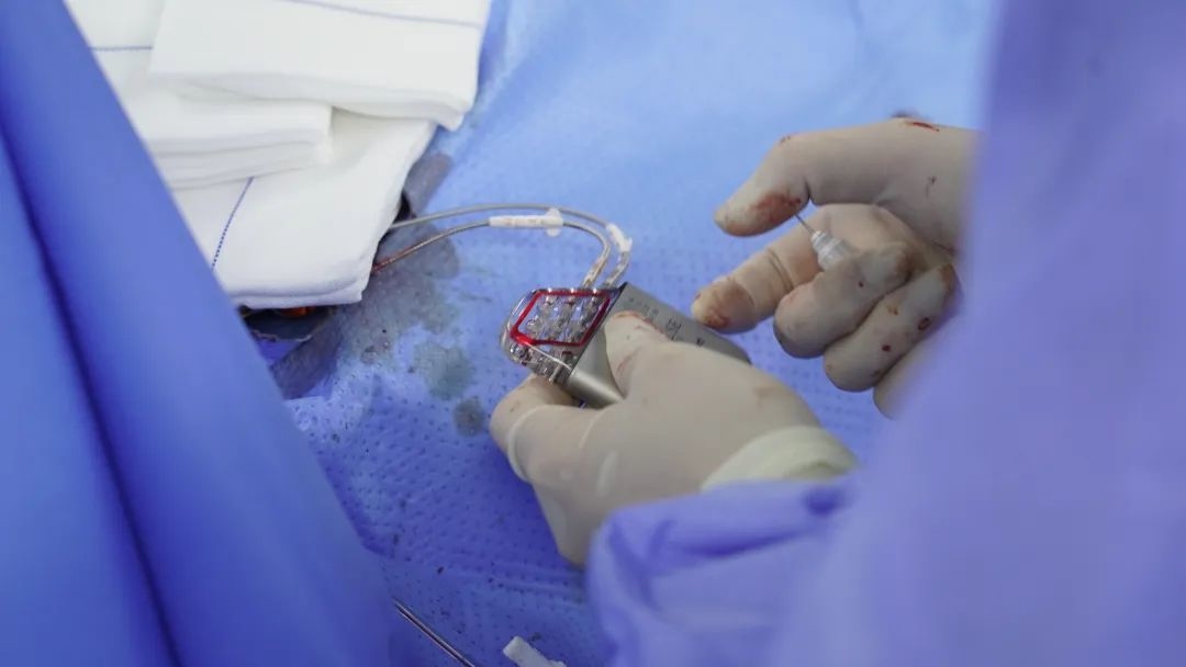 两例省内首次！都在日照这家医院完成！