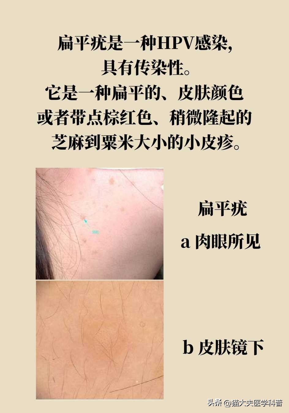 脖子上长的小肉揪怎么治啊,疣丝是不是脖子上的小肉粒