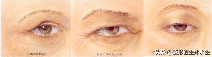 眶周治疗,眶周水肿的处理