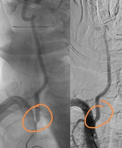 一例头晕，眼睛看东西模糊患者的会诊