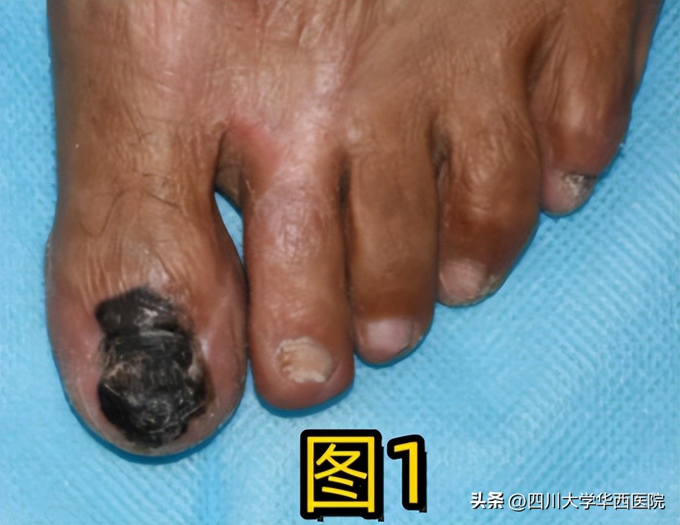 华西专家说，不是转你们，起码有一半的人从没有剪对过指甲儿！