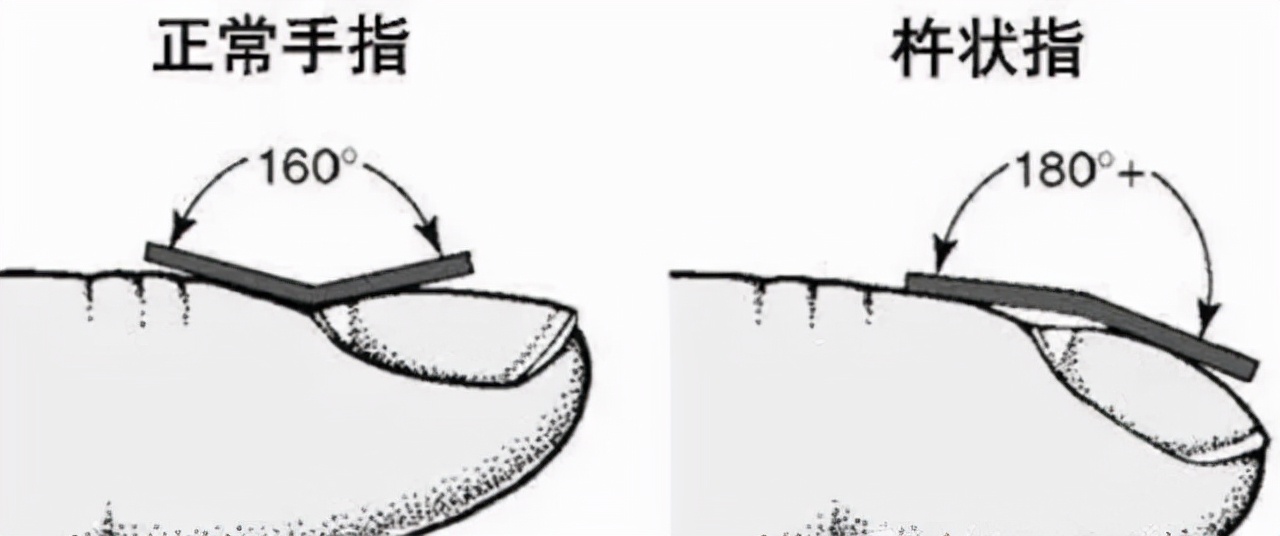 手指变这样是肺癌表现,手指变圆肺癌