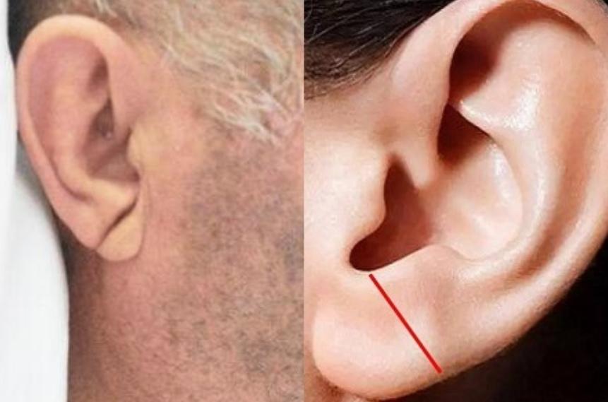 耳朵上有折痕真的是心脏病前兆,耳垂有一道折痕是心梗概率高