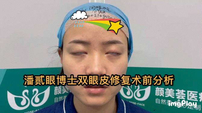整容后眼睛不能闭合,整容失败眼睛无法闭合