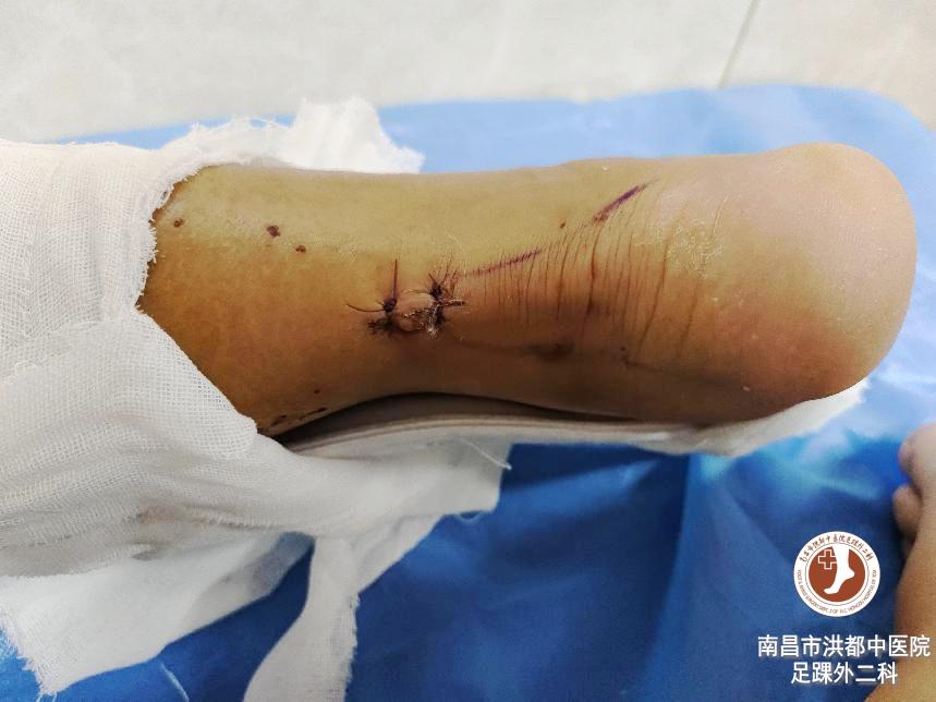 足球运动员韧带断裂修复费用,足球运动员断腿手术