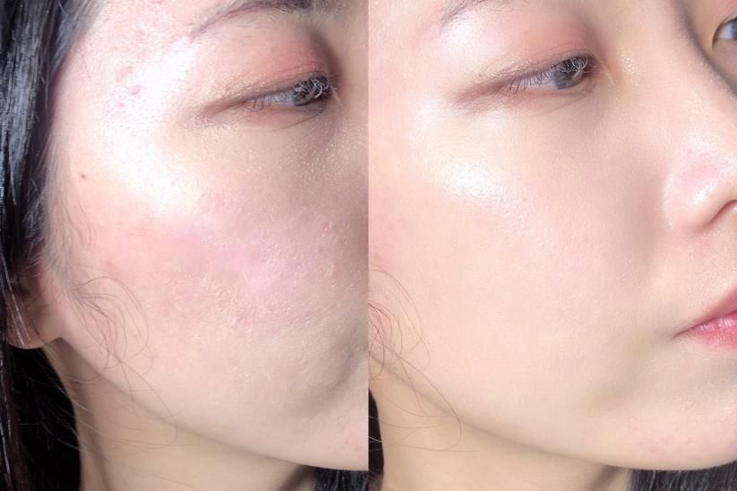 男生脸上很多处脱皮怎么办,男生脸上脱皮干燥