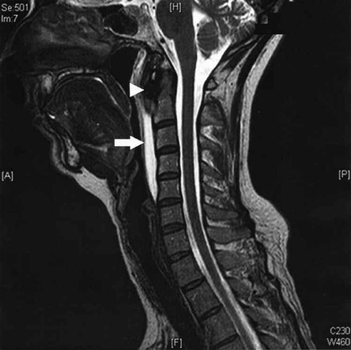 颈长肌腱炎影像表现,三头肌钙化性肌腱炎治疗