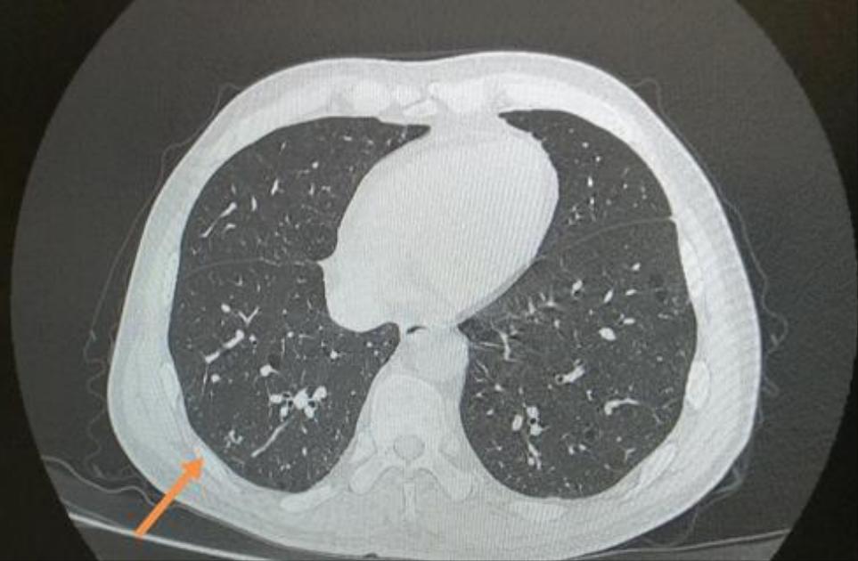 肺结节空泡征一年没变化,肺结节空泡一定恶性吗