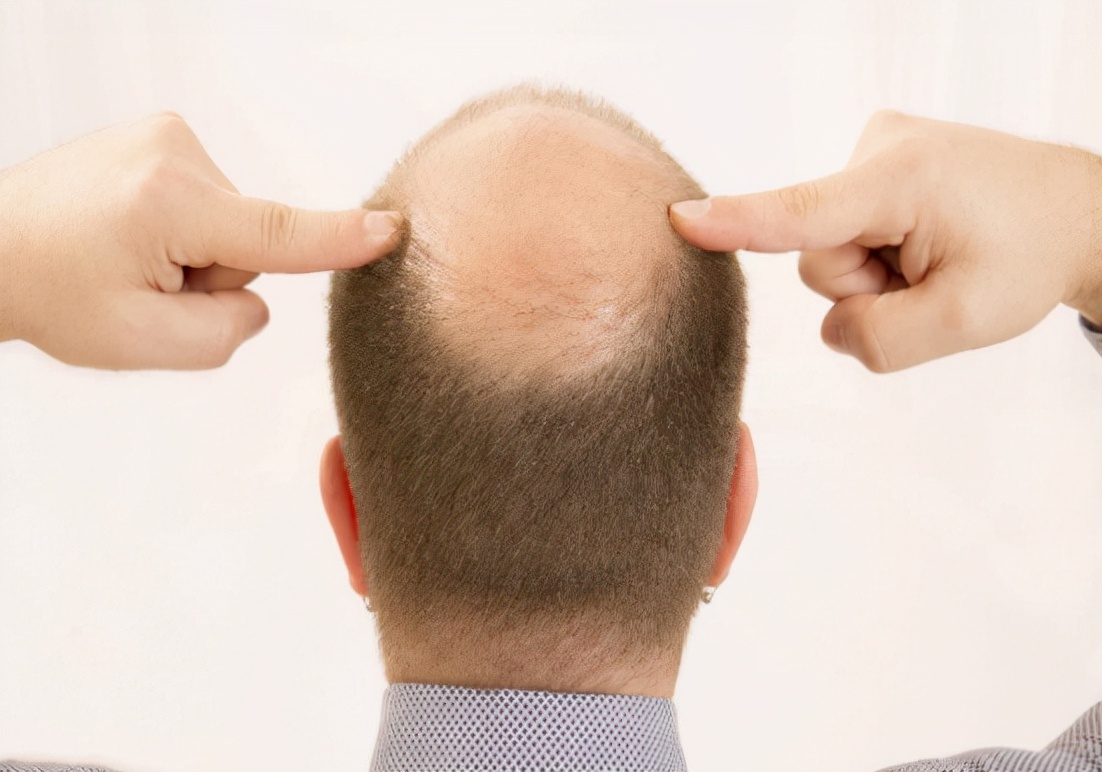 什么脱发用米诺和非那雄胺效果快,男性脱发用米诺地尔女性用什么