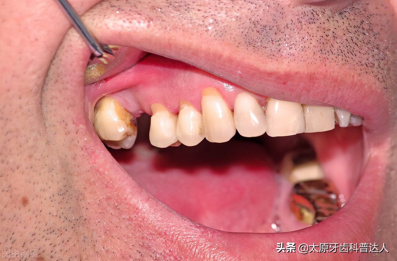 牙齿楔状缺损修补费用,牙齿楔状缺损怎么治疗
