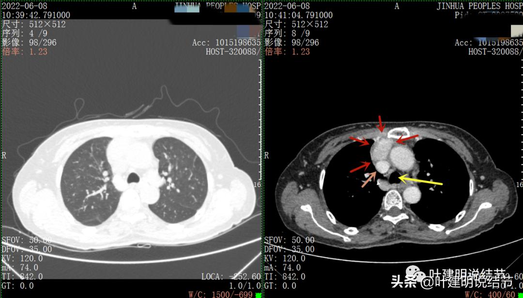 这位老乡，乏力来查，查出这么大个的纵隔肿瘤！会是什么呢？