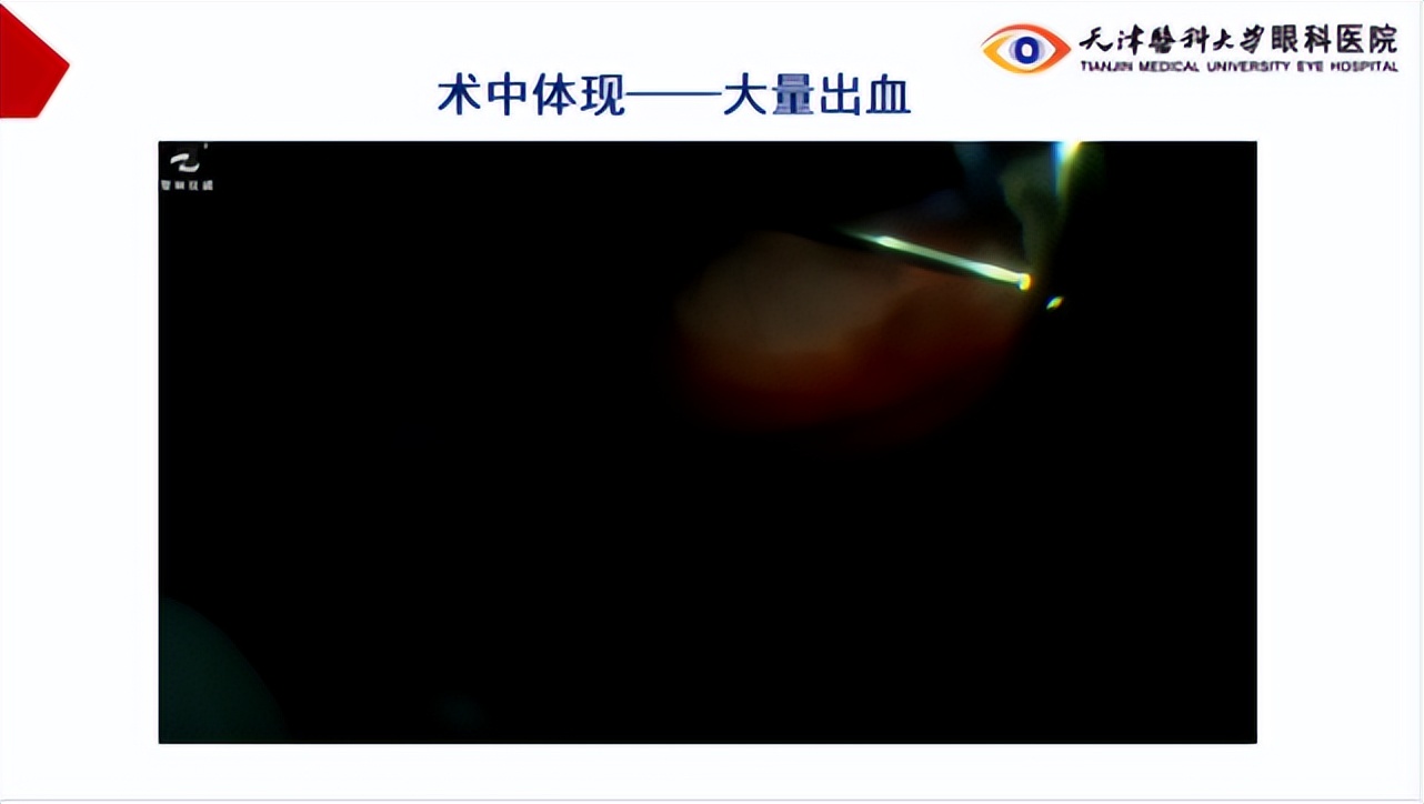 李筱荣教授,天津医科大学眼科医院李筱荣