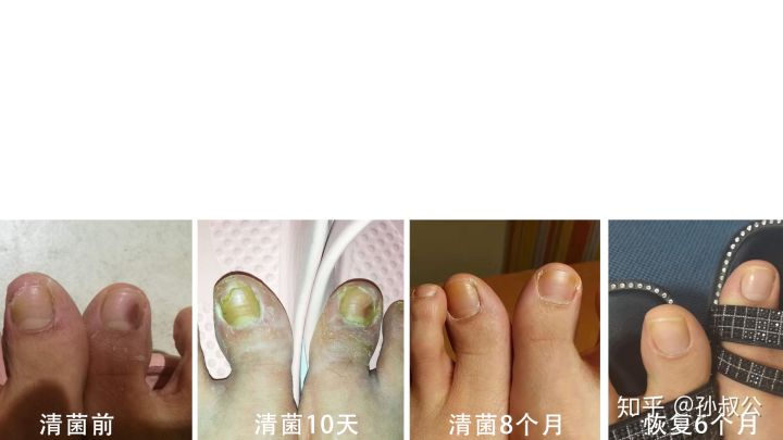 灰指甲的真菌进到甲沟,灰指甲甲根感染用什么消炎