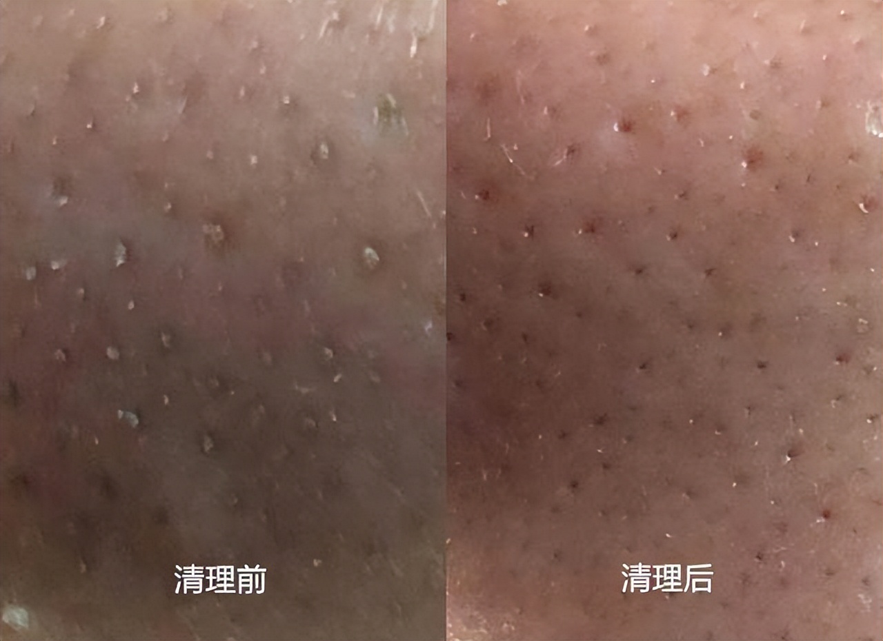 真黑头假黑头傻傻分不清楚，怎么去黑头？