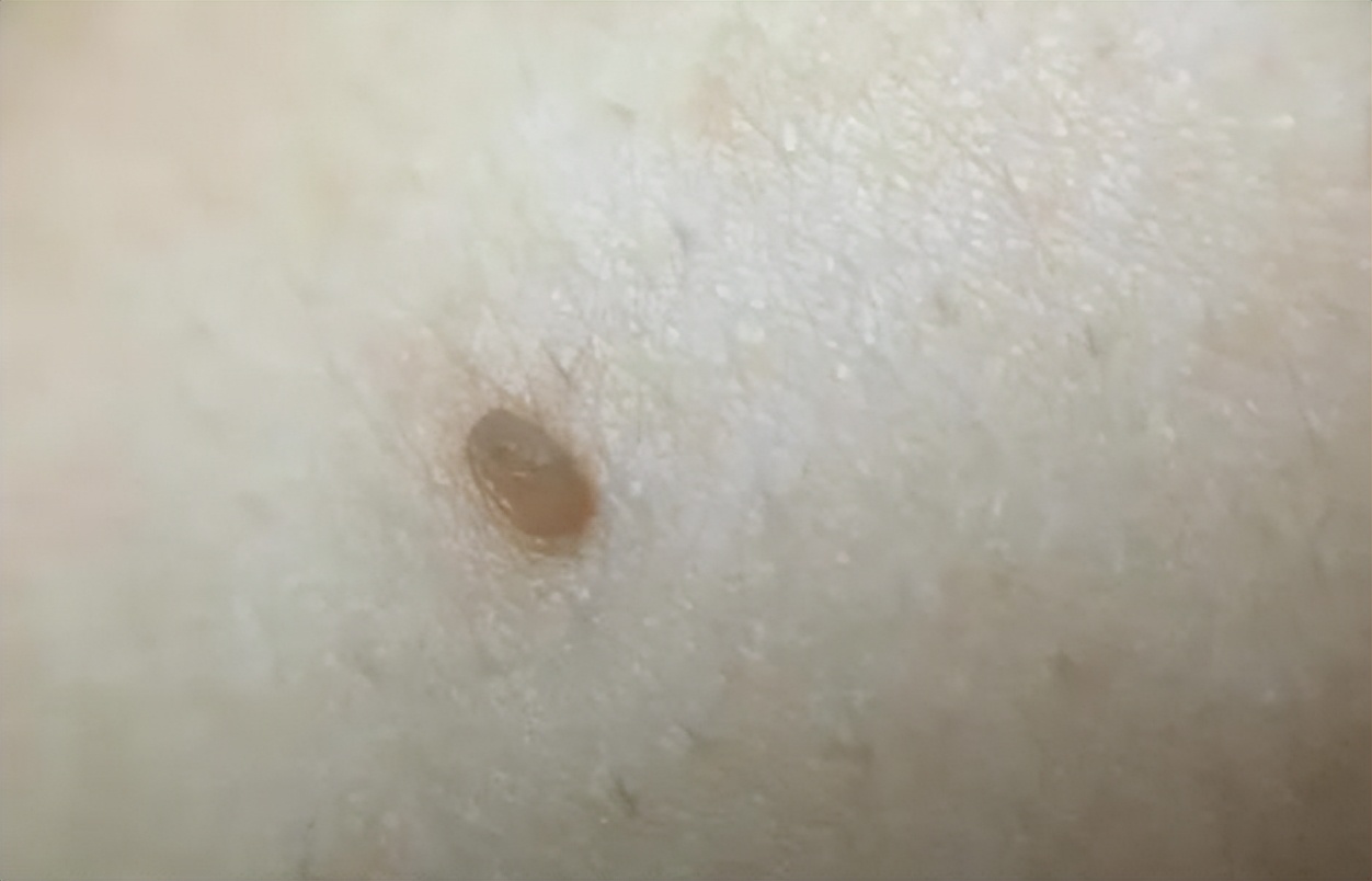 脖子上肉粒可以自己揪掉么,脖子腋下长小肉粒可以用手揪掉吗