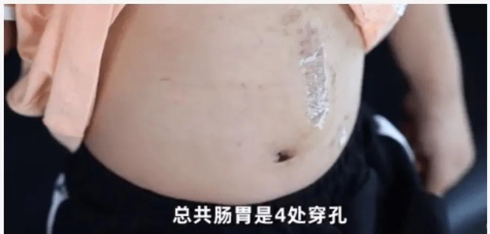 男孩往尿道塞近200颗“玩具球”，喜欢塞东西的熊孩子怎么回事