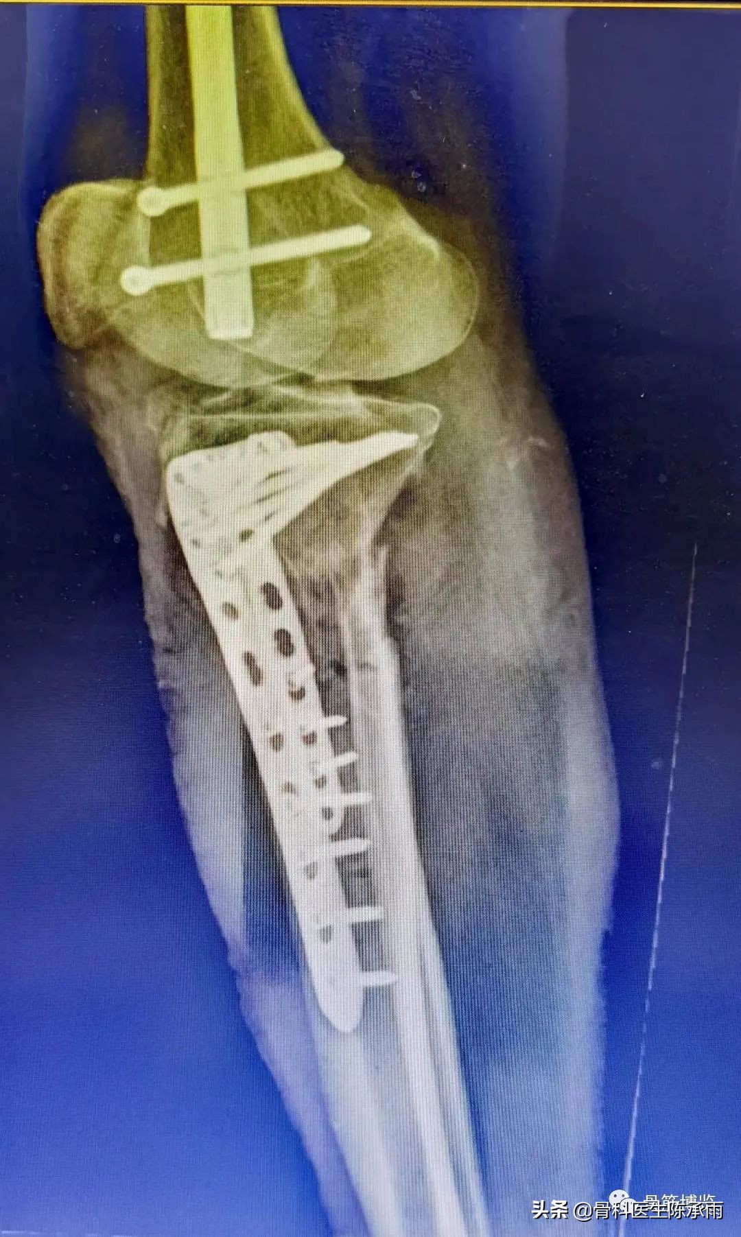 陈旧性腿骨骨折,陈旧性骨折