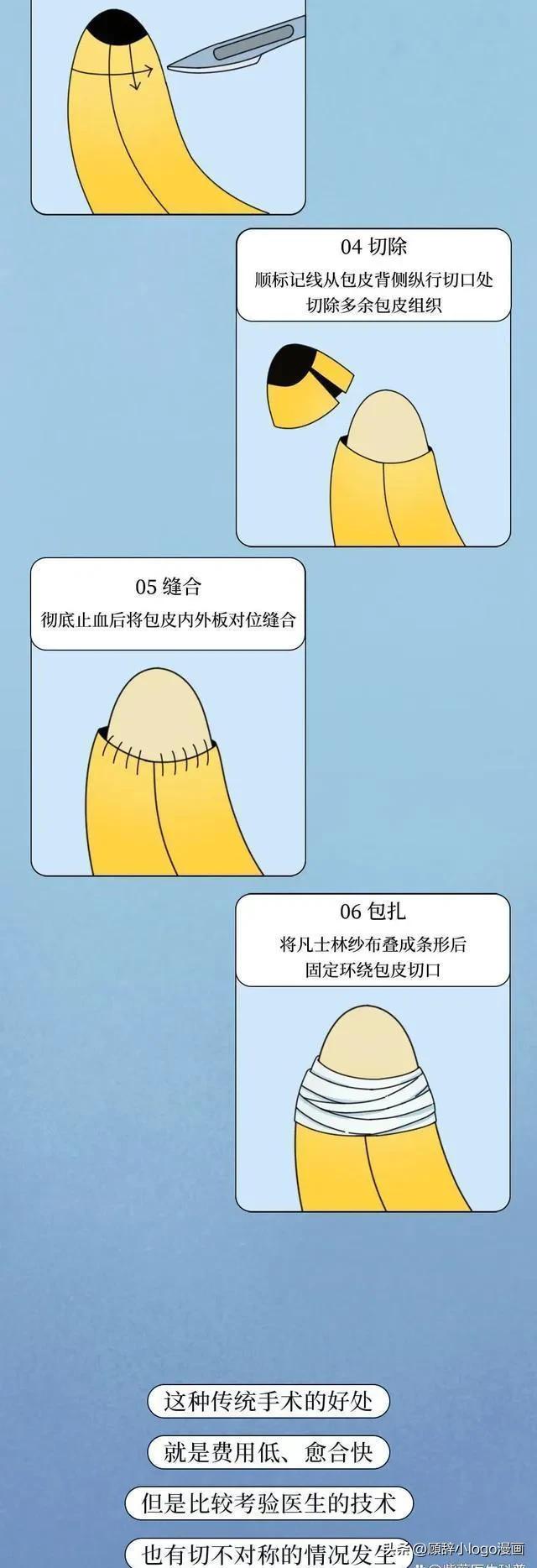 男生割包皮后发生什么变化,男生割包皮以后的变化