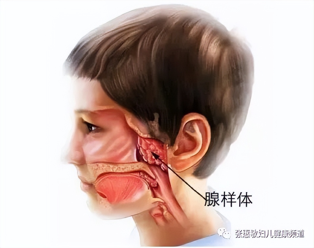 腺样体肥大鼻窦炎症状,鼻炎鼻窦炎鼻甲肥大怎么去辨别