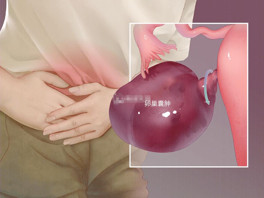 关爱卵巢囊肿,妇女节关爱活动