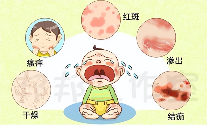 宝宝湿疹老是反反复复怎么办,宝宝湿疹反复发作该怎么办