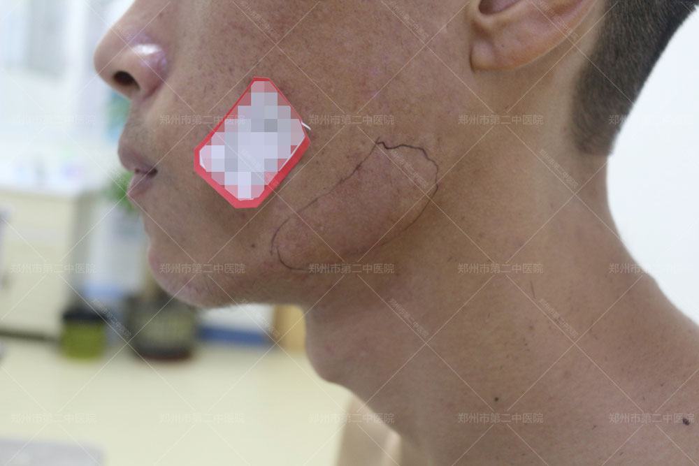 郑州市第一附属人民医院疤痕修复,郑州第二附院疤痕修复价格一览表