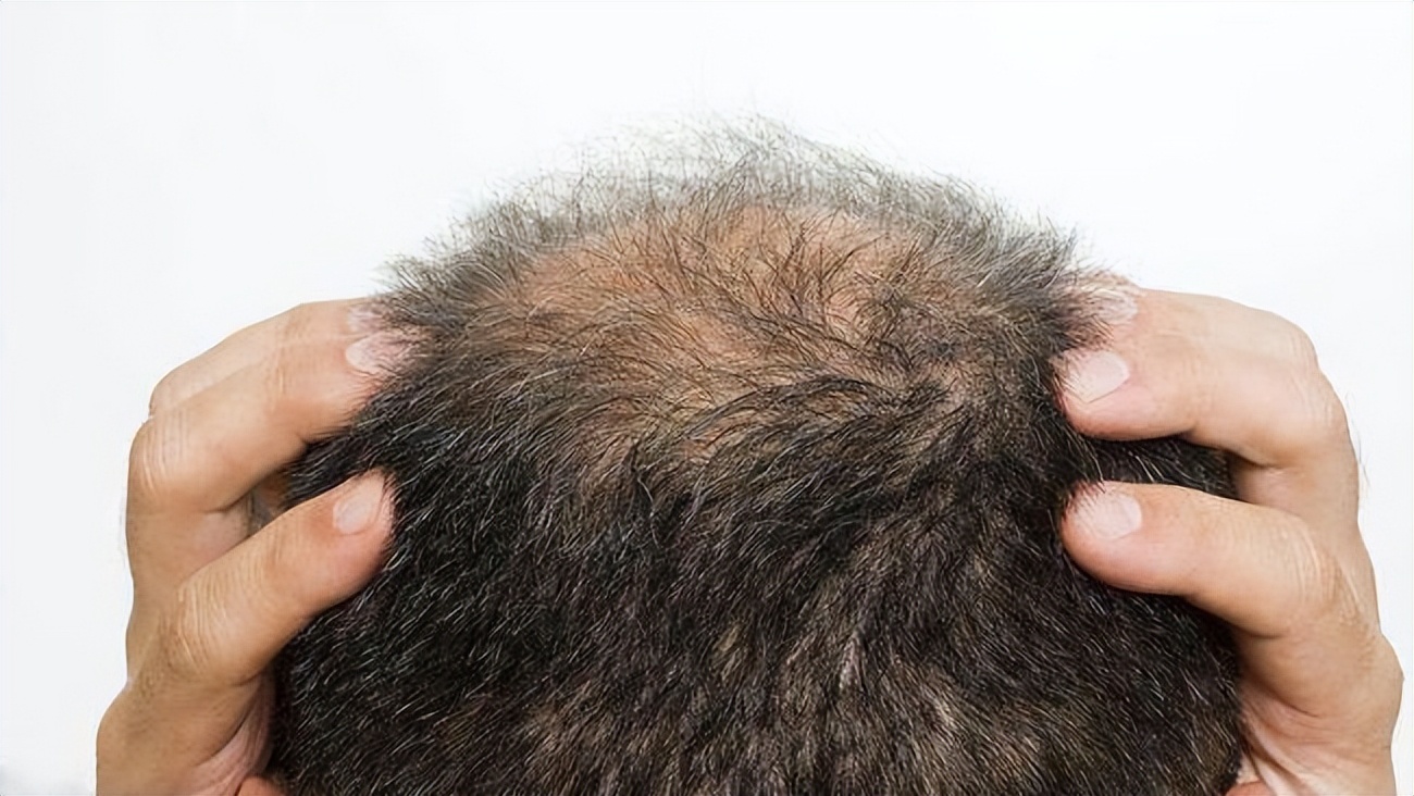 脱发为什么都是从头顶先秃,脱发为什么先从头顶脱