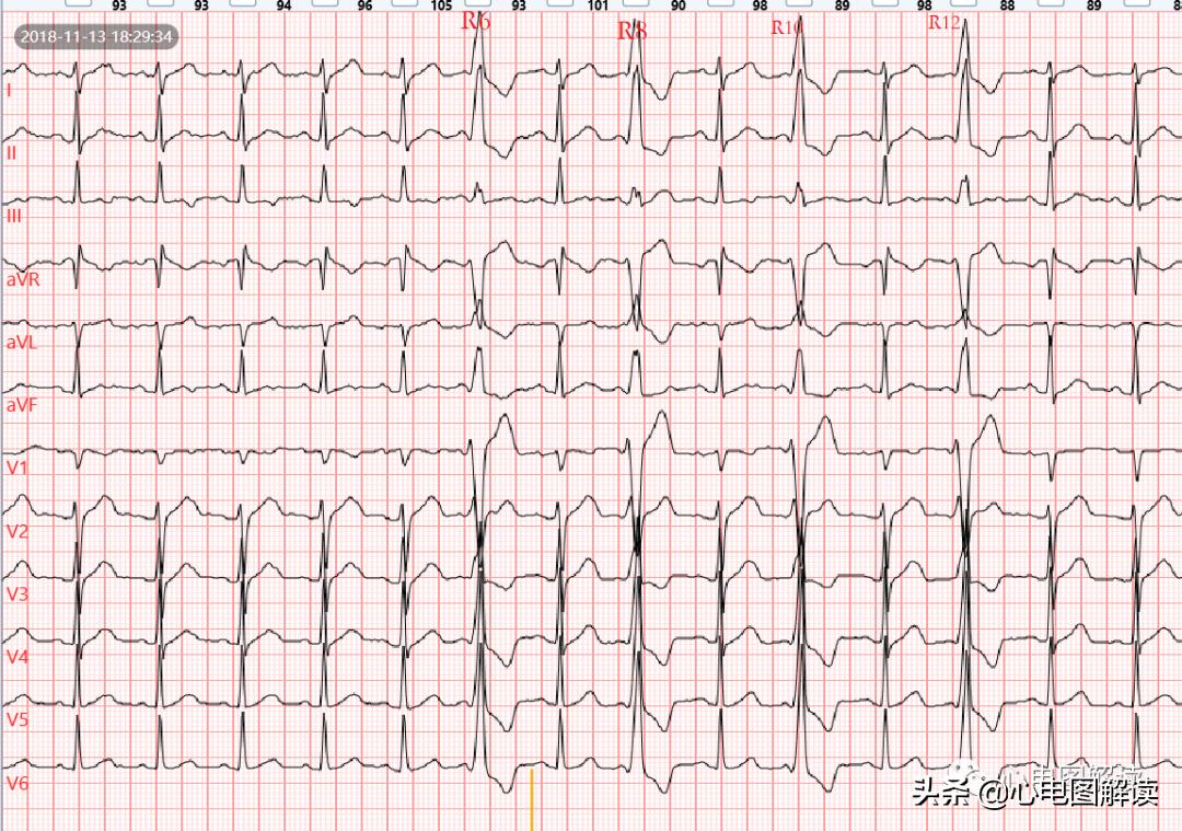 房性早搏与预激综合征,房性早搏伴阵性心动过速