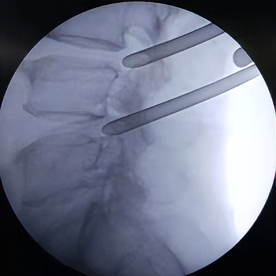 门医技术|门头沟区医院骨二科成功应用微创椎间孔镜技术治疗两例腰椎管多节段狭窄症