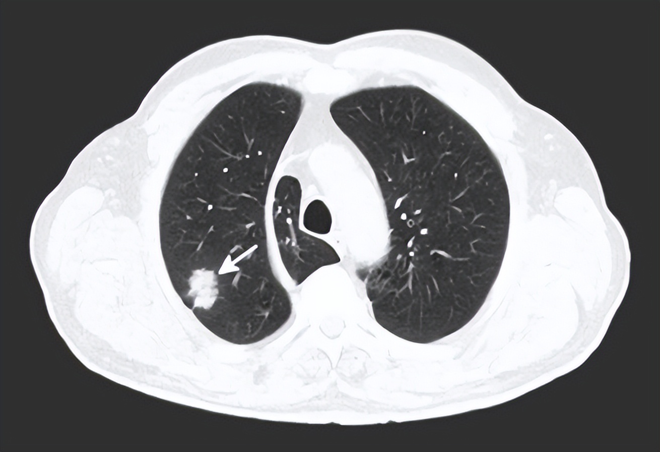 爱闻臭袜子致肺部感染,想闻臭袜子但怕感染怎么办