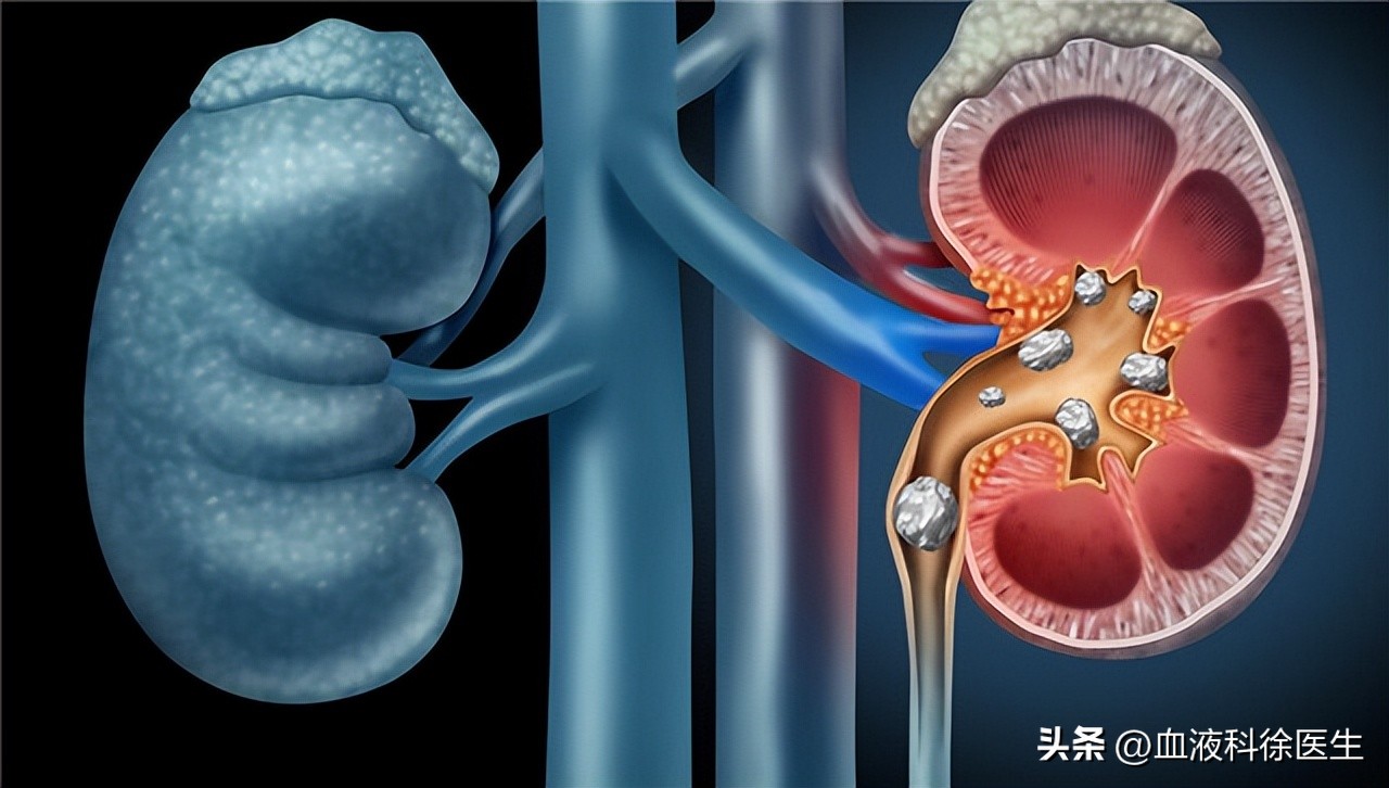 体检出肾结石怎么去医院问诊,体检检查出肾结石怎么处理