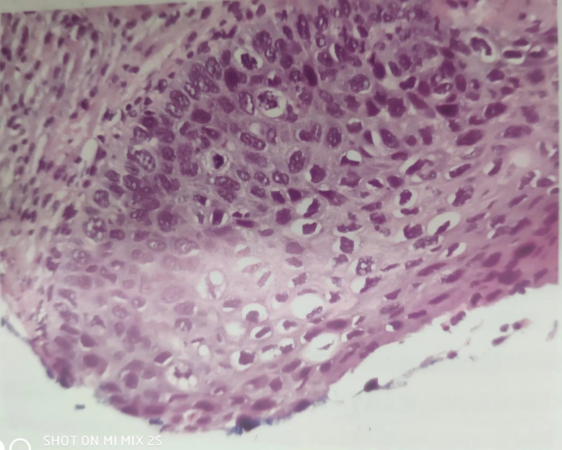 活检结果cin3有可能是宫颈癌吗,宫颈病理报告炎症会显示异常吗