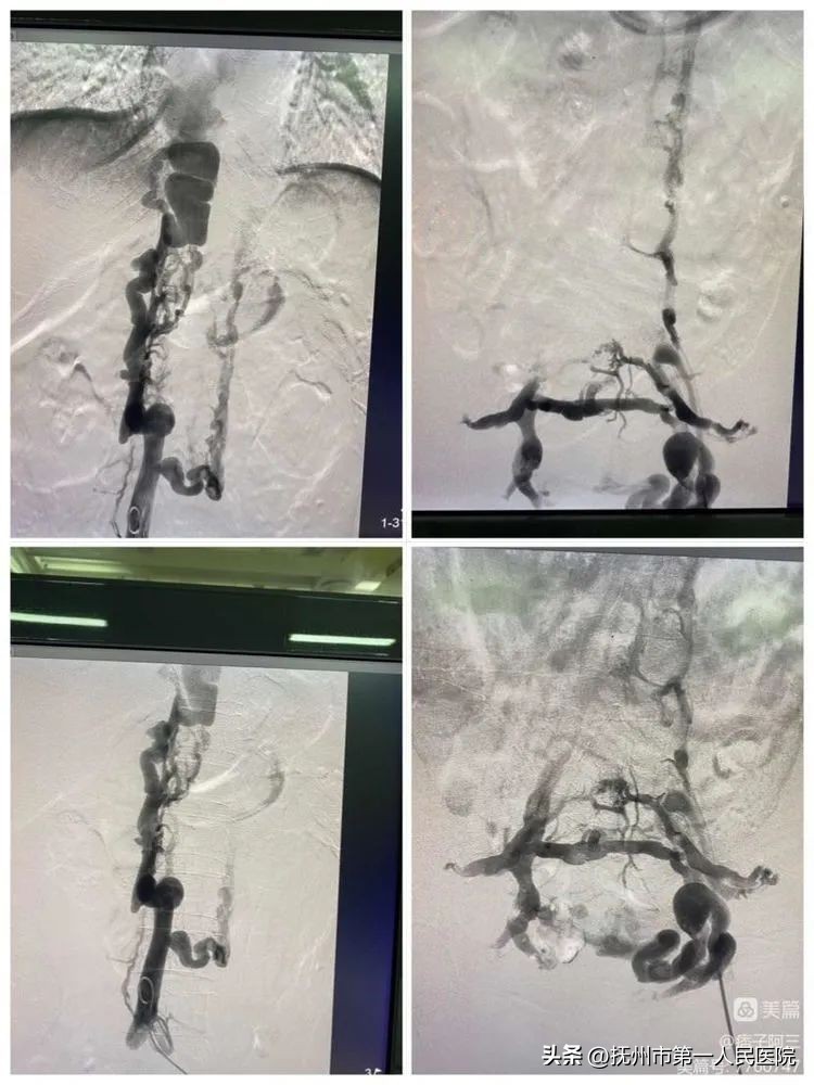 布加氏综合征介入治疗的注意事项,布加综合征介入手术加支架的利弊