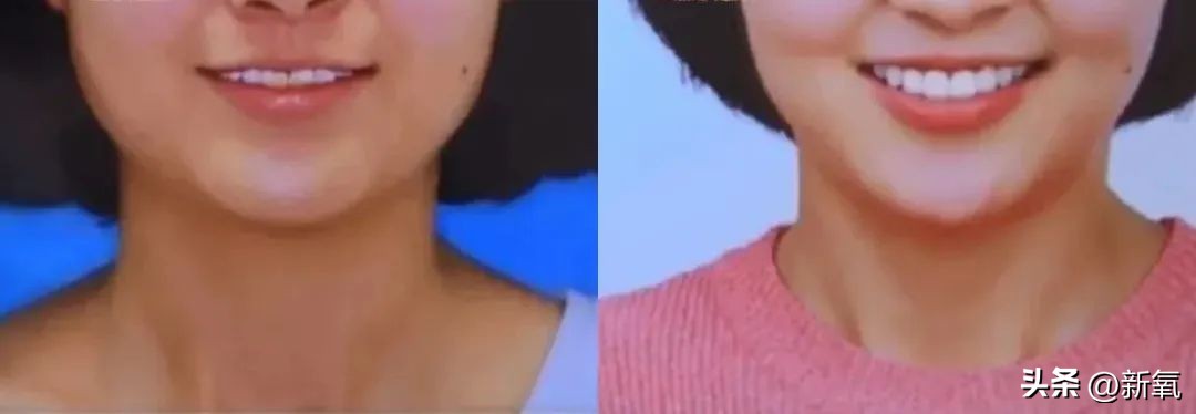 牙齿正畸和骨骼正畸的区别,牙齿正畸和眼轴增长有关系吗