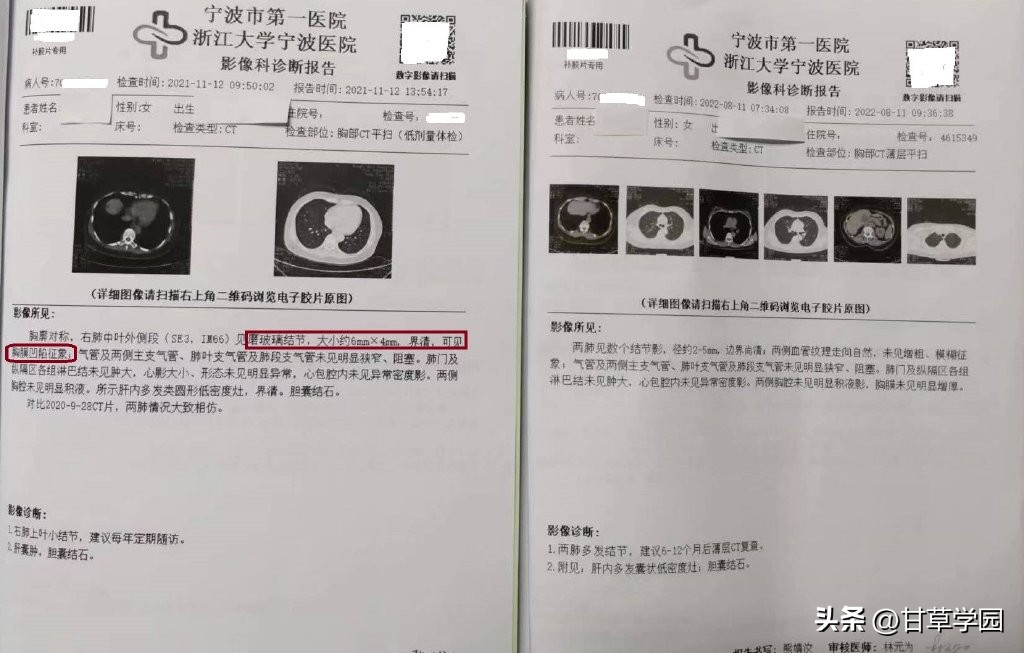 磨玻璃结节胸膜凹陷征象,磨玻璃结节7mmx6mm胸膜凹陷征象