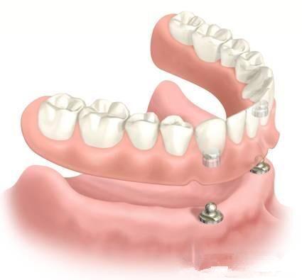 牙齿松动缺失全口修复要多少钱,种植牙之后全口牙齿松动怎么回事