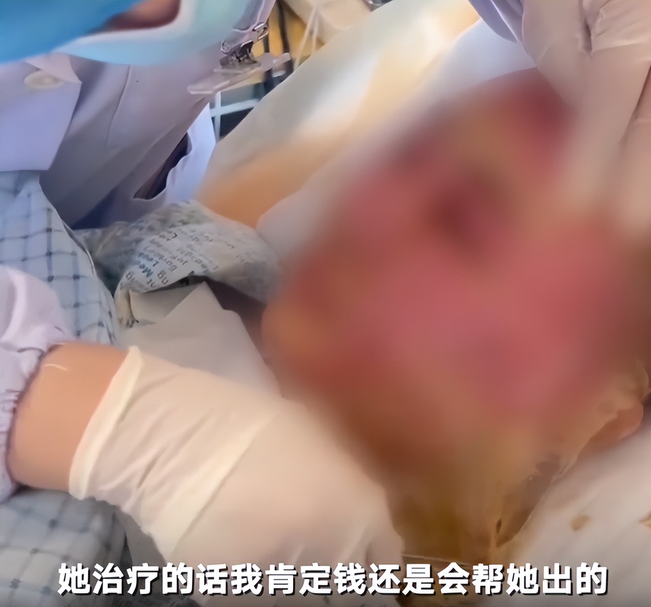 最近新冠的症状以及后遗症,专家判断新冠并没有明显的后遗症