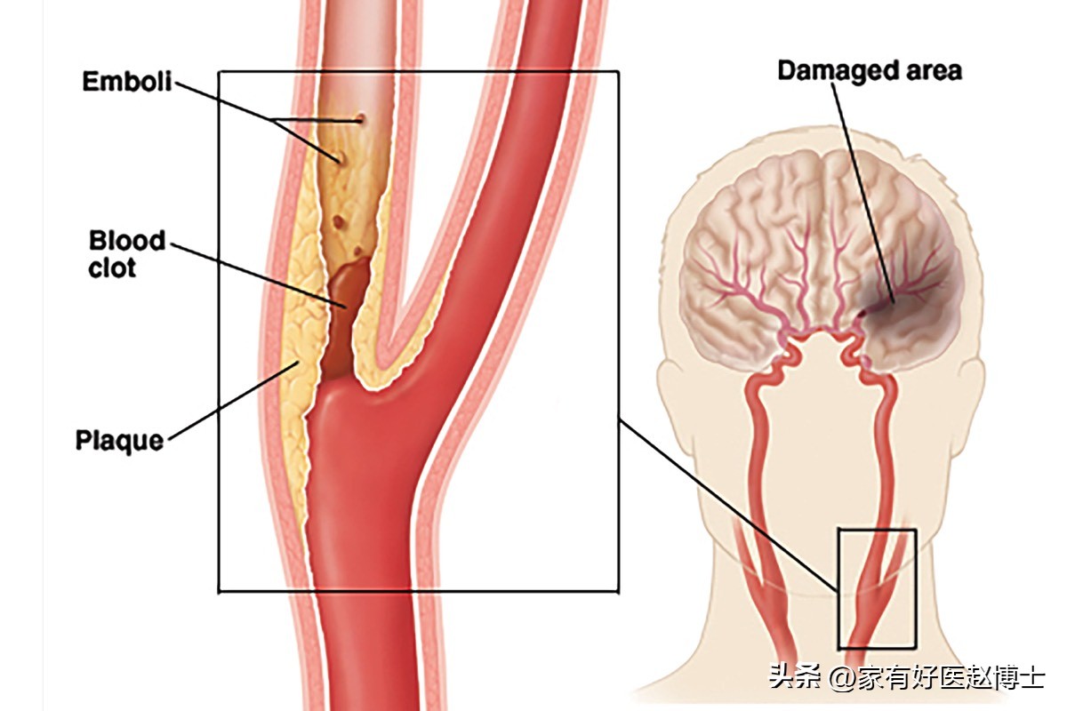 超声检查到的斑块多大才危险,超声检查颈动脉完全闭塞准吗