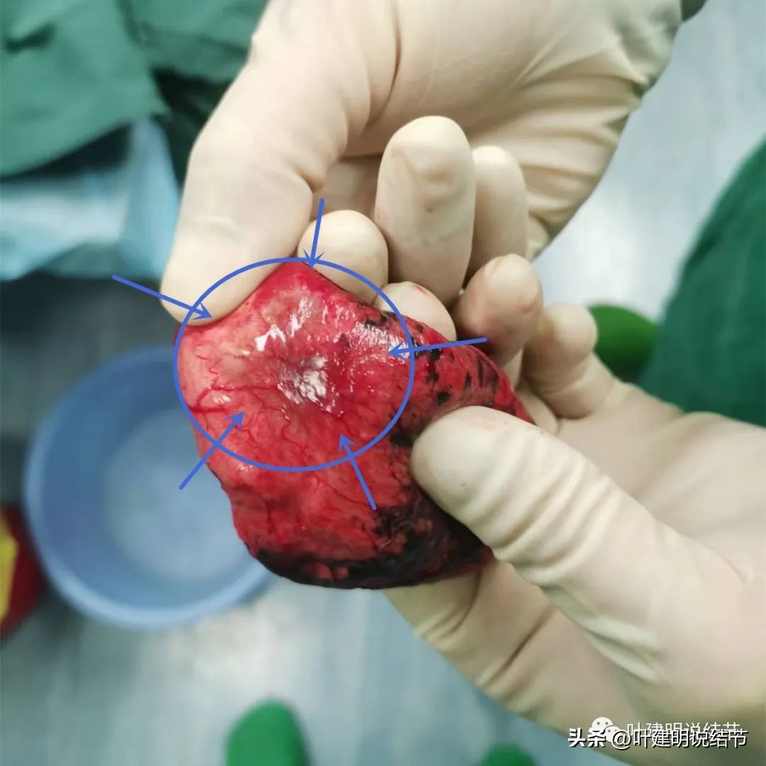 肺癌病理的肿块是硬的吗,肺癌病灶什么样