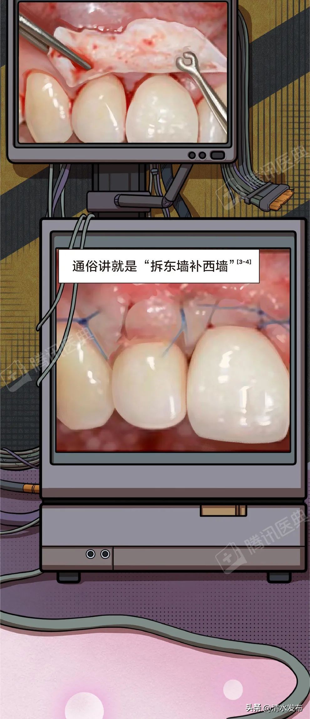 两边大牙一吃肉就塞牙如何修复,14岁学生吃肉老是塞牙需要矫正吗