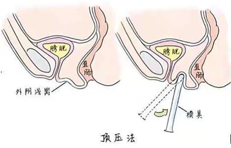 石女再造手术科普,石女通过手术能变成正常女人吗