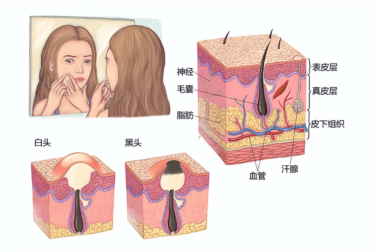 抗痘推荐22岁,青年人痘痘怎么治