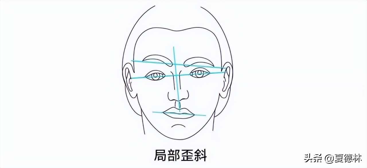 歪脸越来越严重怎么办,偏颌歪脸成人怎么改善