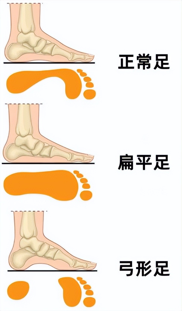 身体好不好，看鞋就知道？骨科医生：鞋底穿成4个模样，该留意了