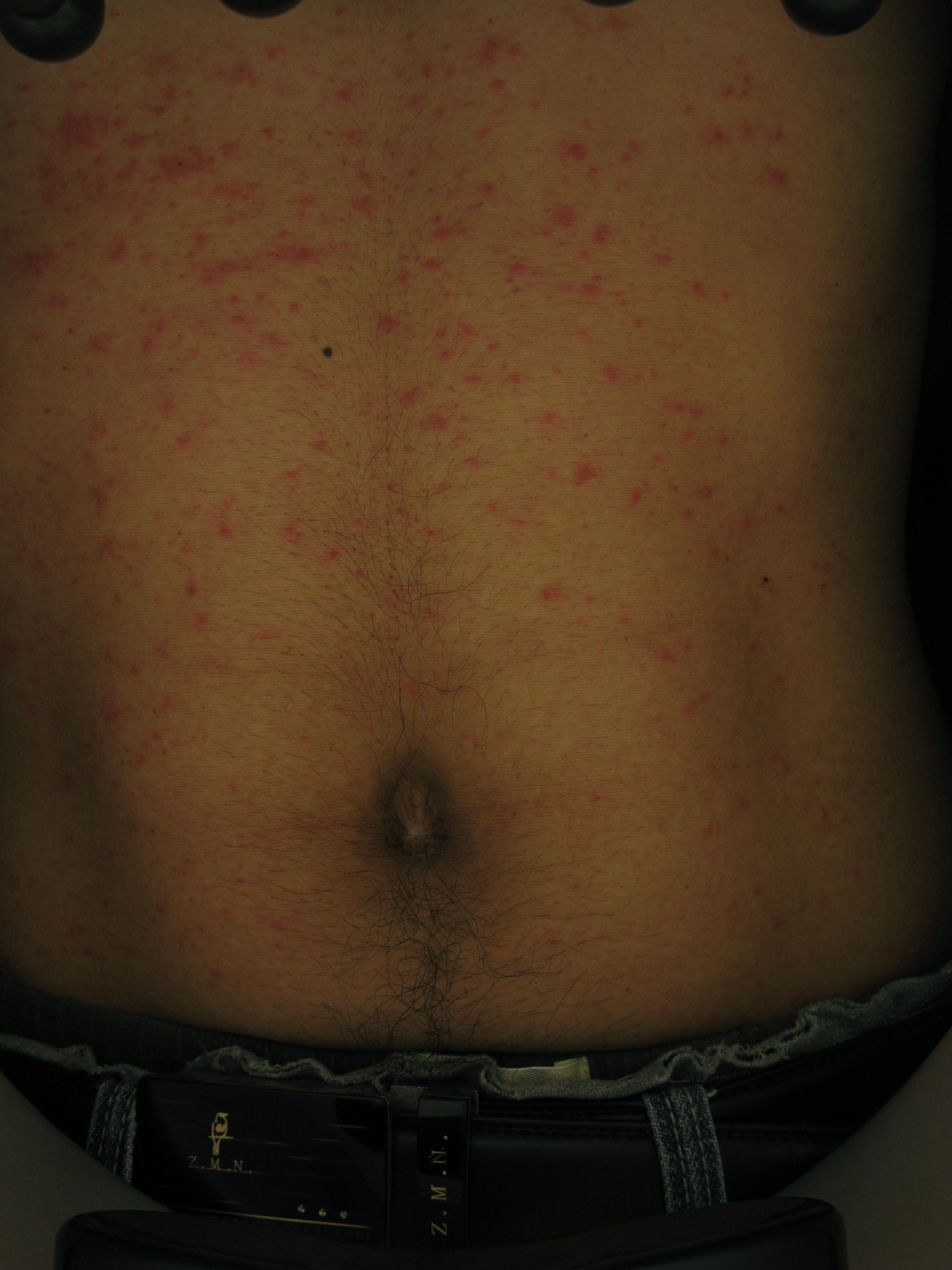 手上有红色的小点点过敏性紫癜,腿上有小红点皮下出血