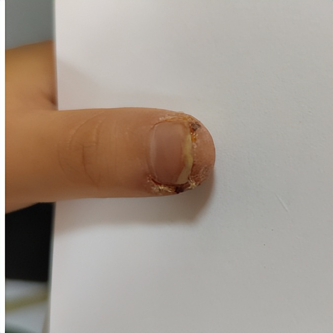 宝宝手指头红肿哭闹,宝宝手指肿胀疼痛是怎么回事