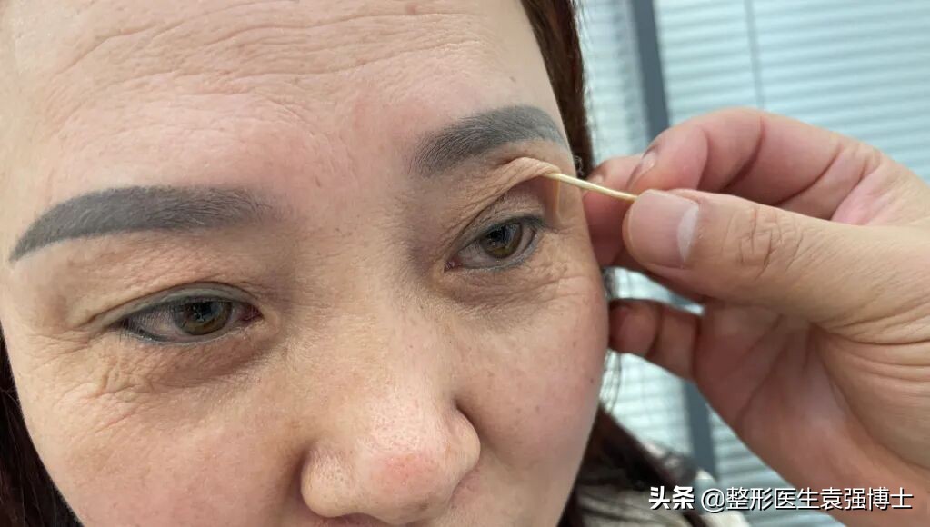 三角眼眼皮松弛怎么做好看,45岁上眼皮松弛下垂出现三角眼
