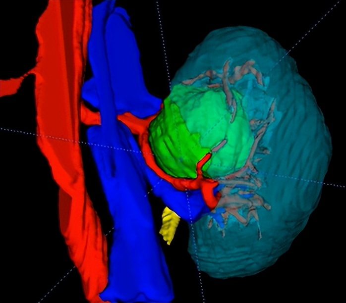 【协和医疗】高难度！泌尿外科朱绍兴教授团队高超“组合拳”完成肾肿瘤保肾手术